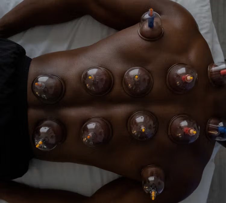 CUPPING THERAPY
